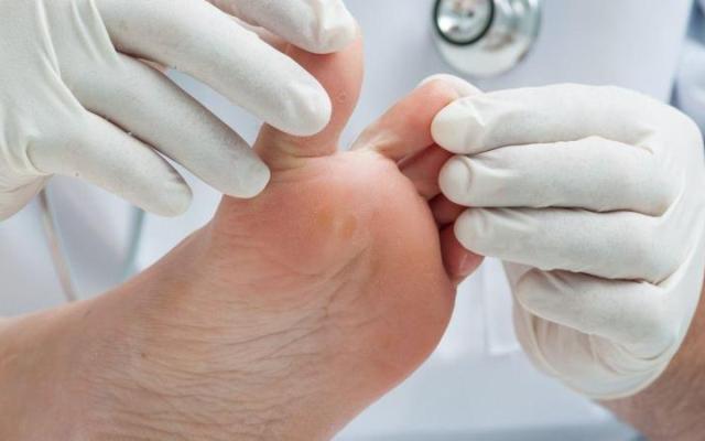 Что нужно знать о грибковых заболеваниях кожи стоп и ногтей