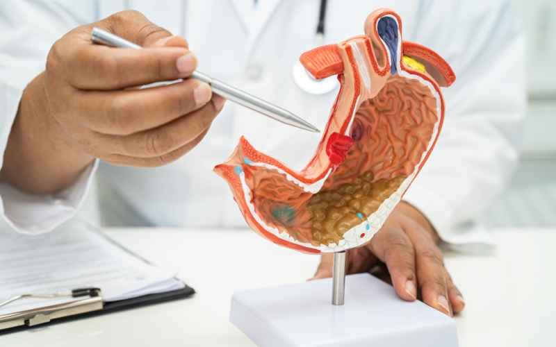 Достижения в области скрининга на пищевод Барретта и аденокарциному пищевода (Mayo Clinic Proceedings, январь 2024)