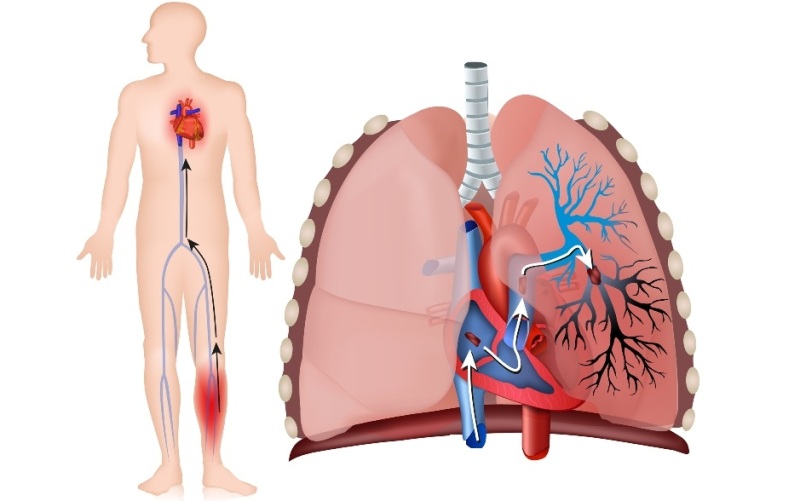 Тромбоэмболия легочной артерии (тэла). Тромб кашель. Тромбоэмболия легочной артерии. Тромб кашель. Патогенез тромбоза глубоких вен.