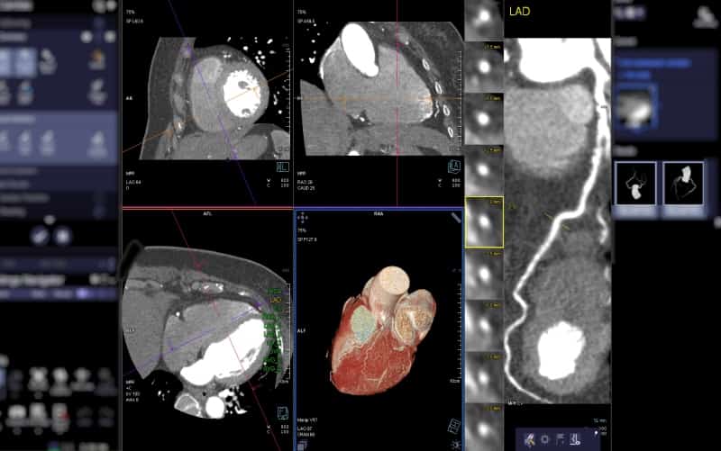 Роль компьютерной томографии при структурных заболеваний сердца (Advances in Clinical Radiology, июнь 2024)