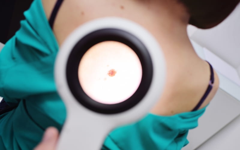 Контагиозный моллюск. Клинический протокол МЗ России