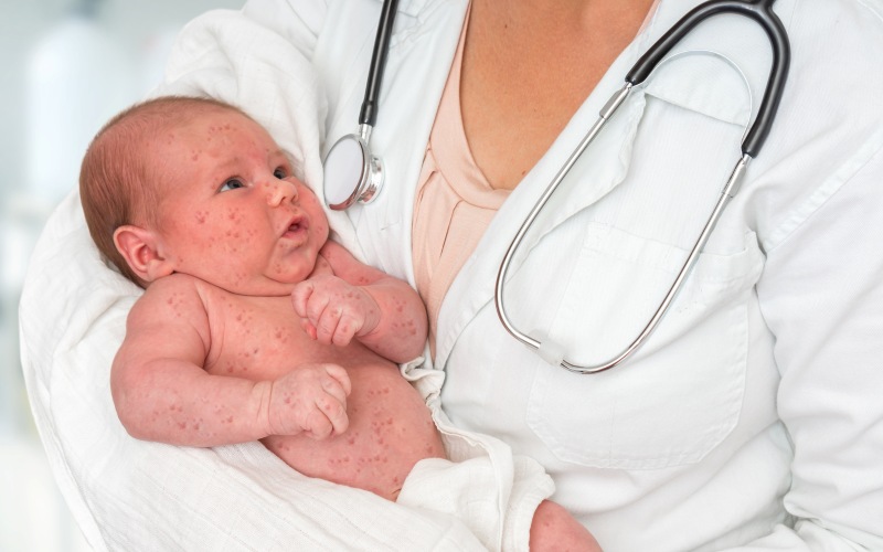 Краснуха. Клинический протокол МЗ Кыргызстана