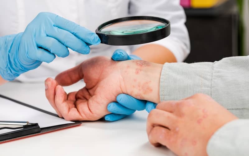 Розовый лишай Жибера. Клинические рекомендации МЗ России