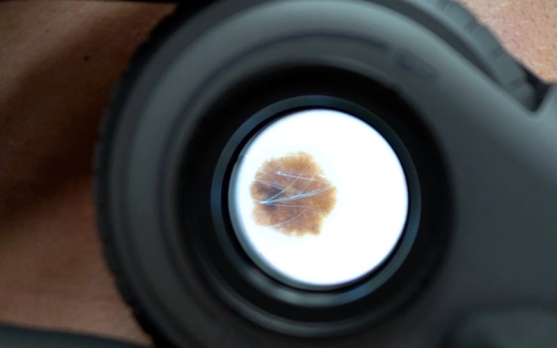 Акрально-лентигинозная меланома (JAAD, январь 2026)