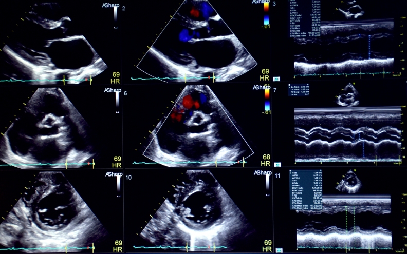 Перипартальная кардиомиопатия (New England Journal of Medicine, январь 2024)