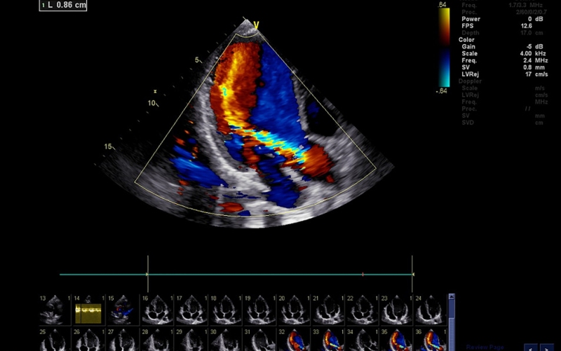 Эхокардиографическая оценка правых отделов сердца: текущие и будущие достижения (Current Cardiology Reports, декабрь 2023)