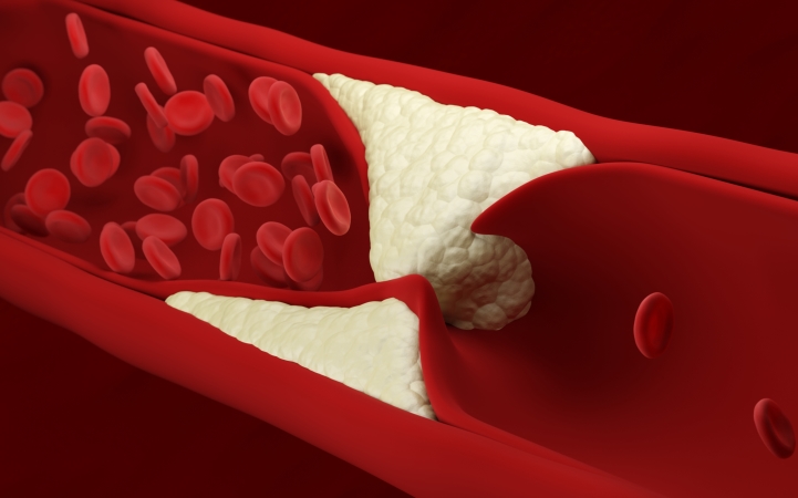 Персонализированное вмешательство, основанное на раннем выявлении атеросклероза (JACC, май 2024)