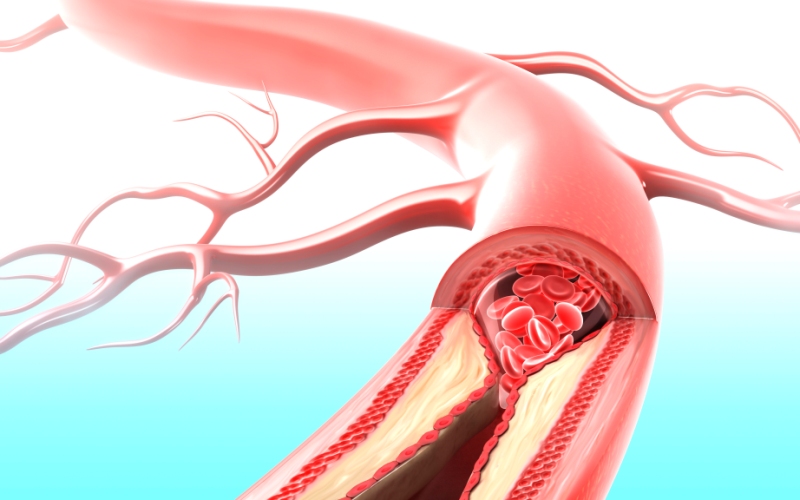 Связка "ремнантный холестерин / С-реактивный белок" (Atherosclerosis, август 2023)