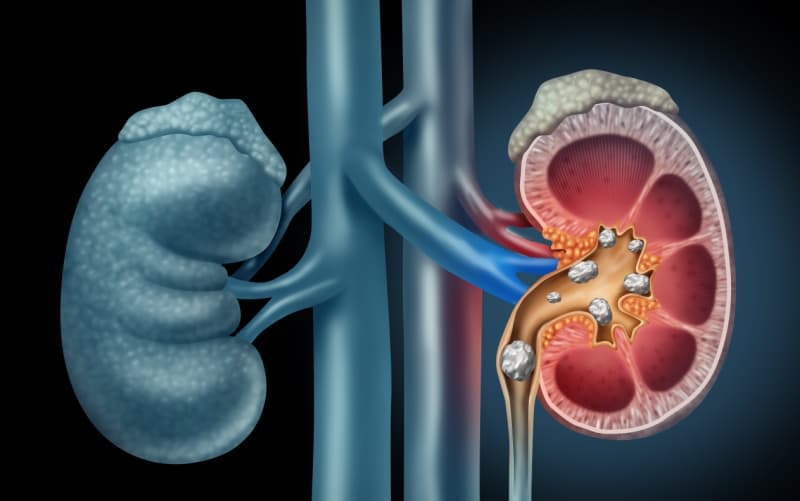 Аутосомно-доминантная поликистозная болезнь почек (American Journal of Kidney Diseases, август 2025)
