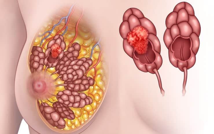 Протоковая карцинома молочной железы in situ: поиск баланса между чрезмерным и недостаточным лечением (Lancet, май 2024)