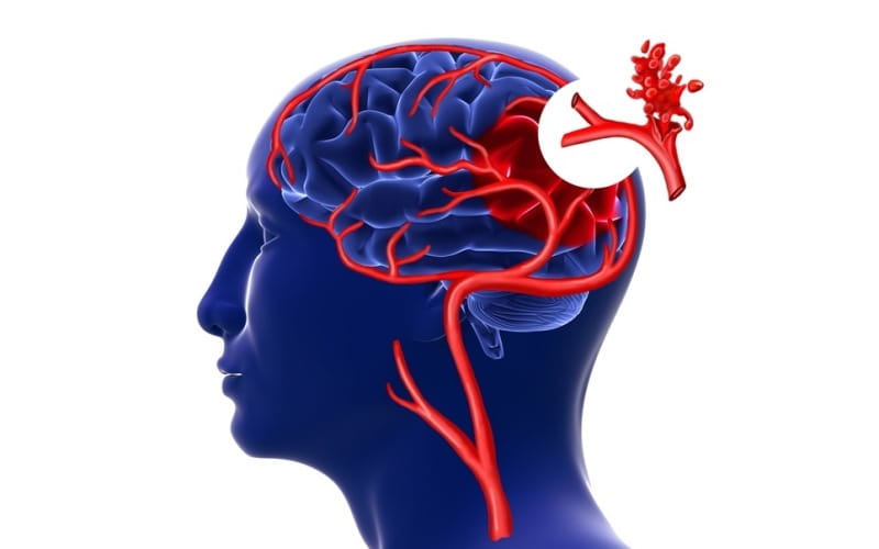 Инсульт (Lancet, май 2024)