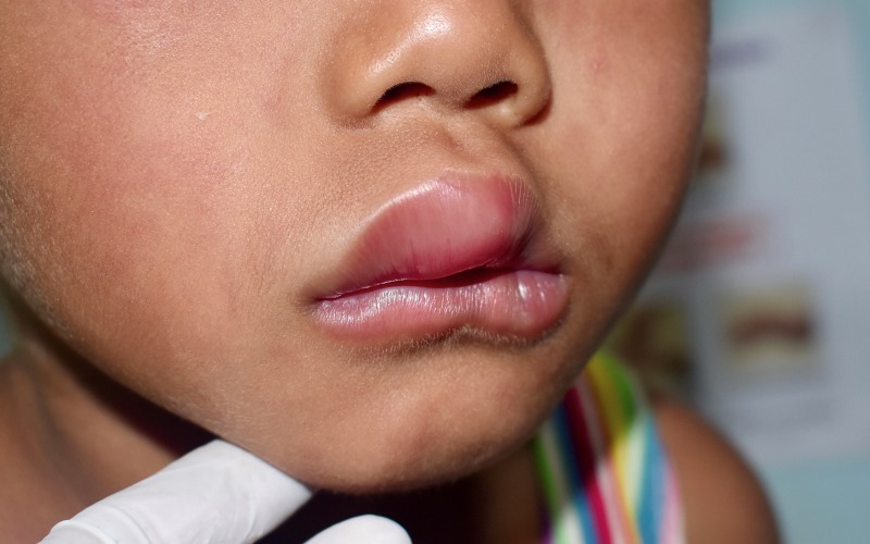 Международное/канадское руководство по наследственному ангионевротическому отеку (Allergy, Asthma & Clinical Immunology Article, январь 2026)