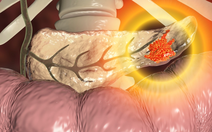 Лечение резектабельного, погранично-резектабельного и местнораспространенного рака поджелудочной железы (Annals of Surgical Oncology, ноябрь 2023)
