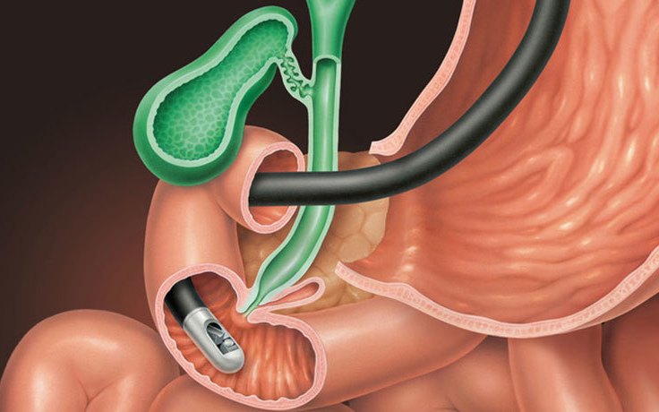 Профилактика пост- ЭРХПГ панкреатита (ASGE, декабрь 2022)