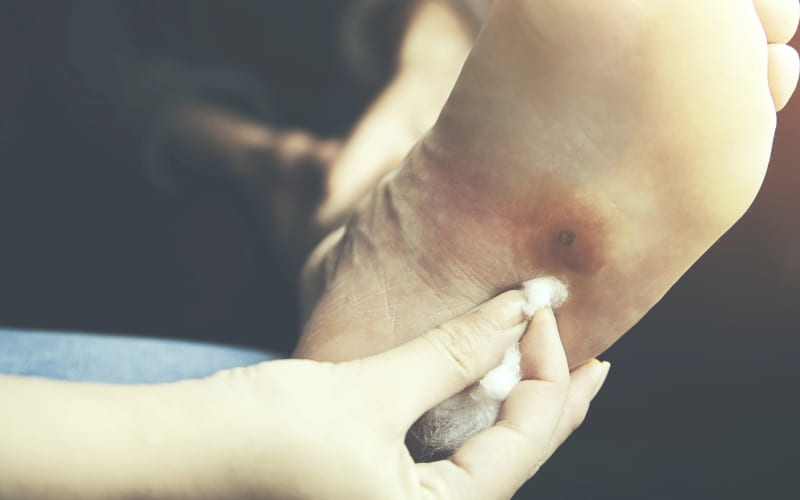 Причины, профилактика и лечение язв на стопах, связанных с диабетом (Lancet Diabetes & Endocrinology, июль 2024)