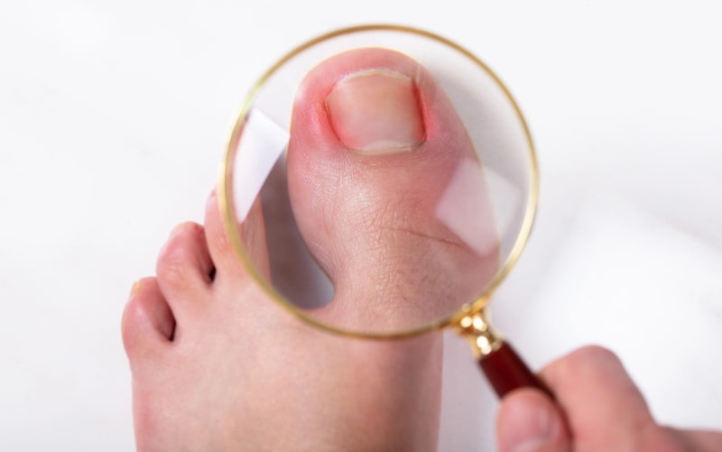 Вросший ноготь (онихокриптоз). Клинические рекомендации МЗ России