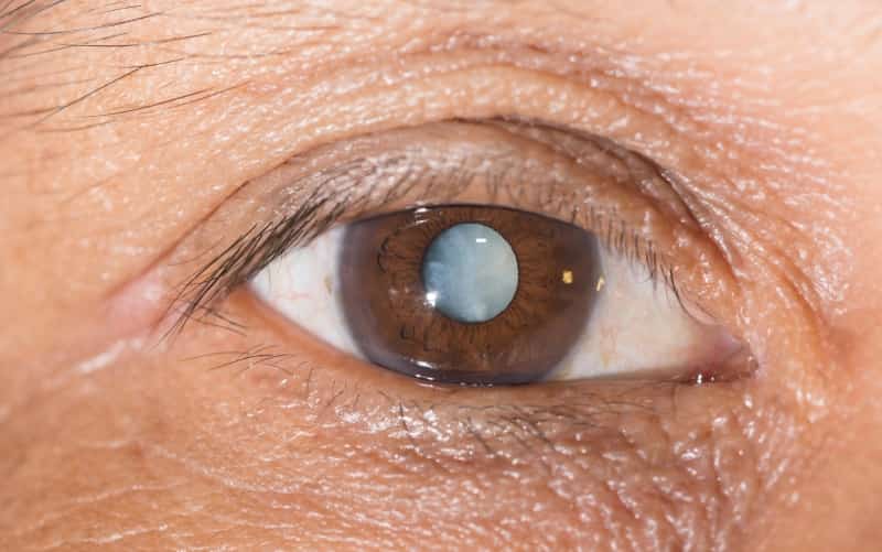 Ретинальные артериальные окклюзии. Клинические рекомендации МЗ России