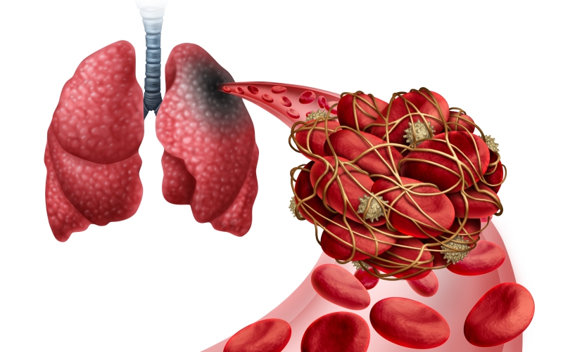 Современное лечение и исходы пациентов с тромбоэмболией легочной артерии высокого риска (JACC, январь 2024)