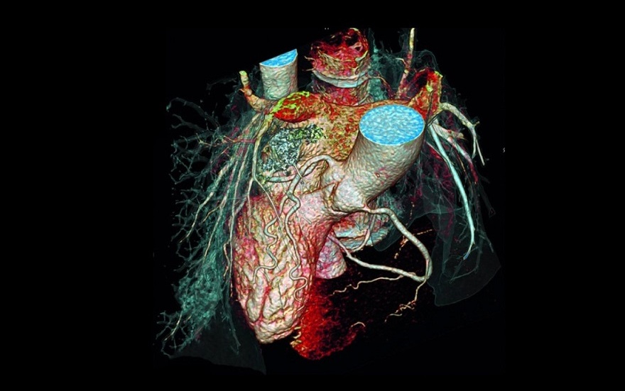 Кальцификация коронарных артерий: современные концепции и клинические последствия (Circulation, январь 2024)