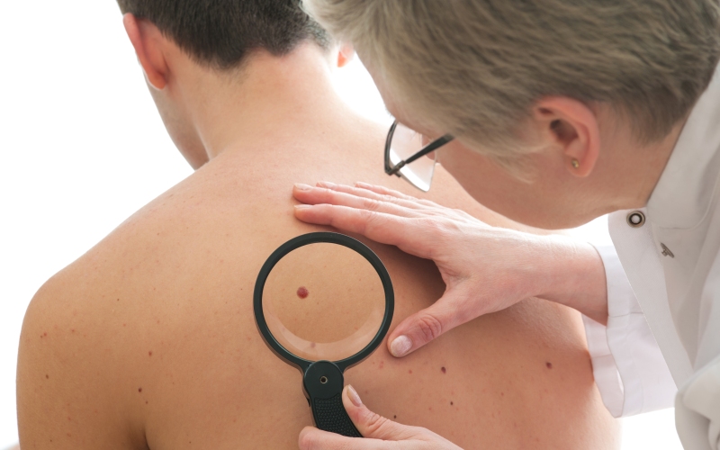 Меланома кожи и слизистых оболочек. Клинические рекомендации МЗ России