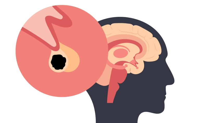 Предлагаемая клиническая классификация новообразований гипофиза (Lancet Diabetes & Endocrinology, январь 2024)