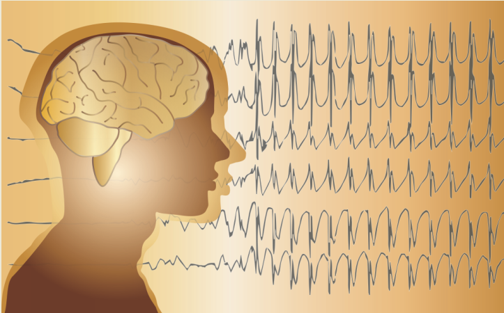 При сомнениях, возвращайтесь к основам (Epileptic Disorders, август 2023)