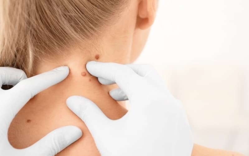 Акрально-лентигинозная меланома (JAAD, январь 2026)