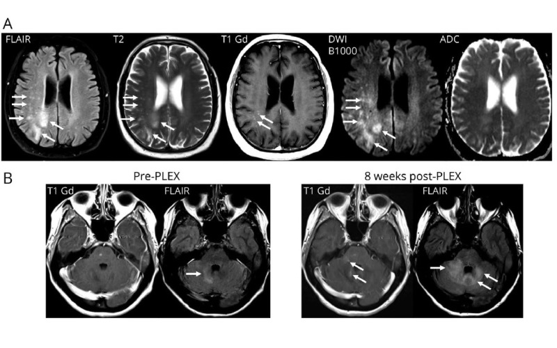 Прогрессирующая мультифокальная лейкоэнцефалопатия: патогенез, диагностика и потенциальные биомаркеры ответа на терапию (Neurology, октябрь 2023)