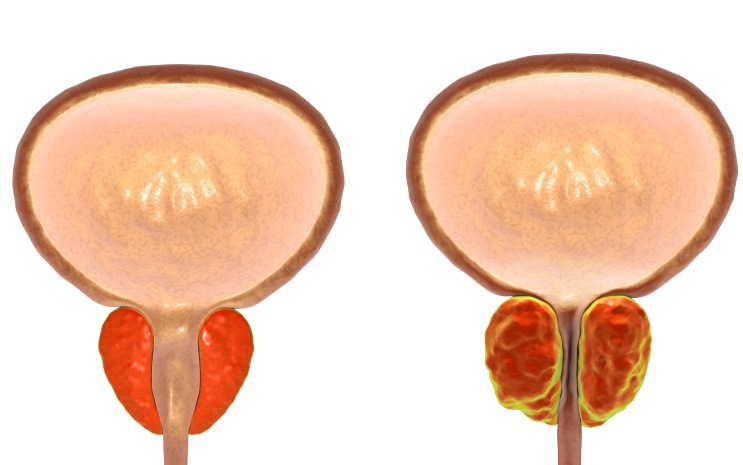 Сравнение малоинвазивных процедур при доброкачественной гиперплазии предстательной железы: анализ экономической эффективности (Radiology, декабрь 2023)
