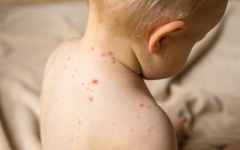 Корь. Клинический протокол МЗ Кыргызстана