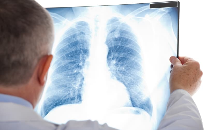 Туберкулёз (Annals of Internal Medicine, сентябрь 2026)