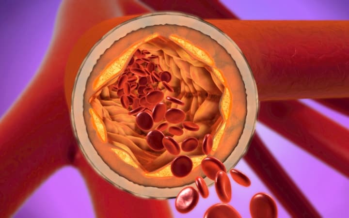 Венозный и артериальный тромбоз у пациентов с синдромом VEXAS (Blood, февраль 2024)