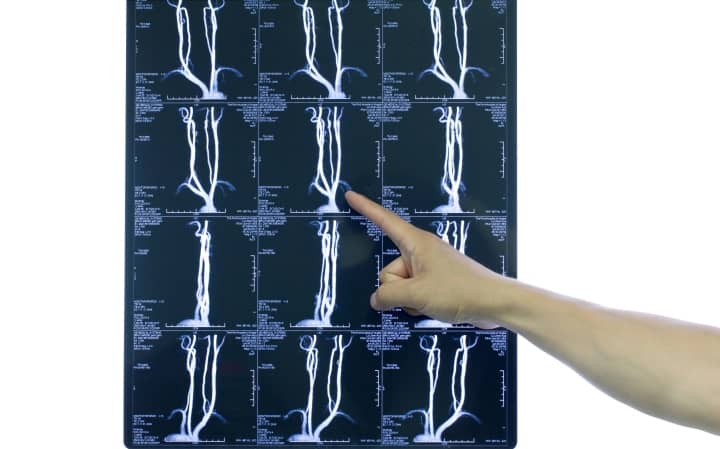 Тотальный спинальный блок после акушерской нейроаксиальной блокады (International Journal of Obstetric Anesthesia, апрель 2024)