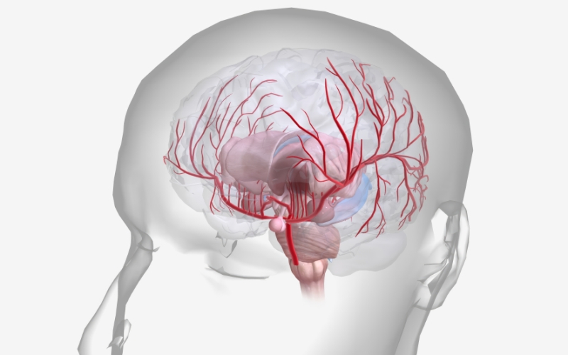 Разрыв аневризмы в реальном времени во время ангиографии (Stroke, июнь 2023)