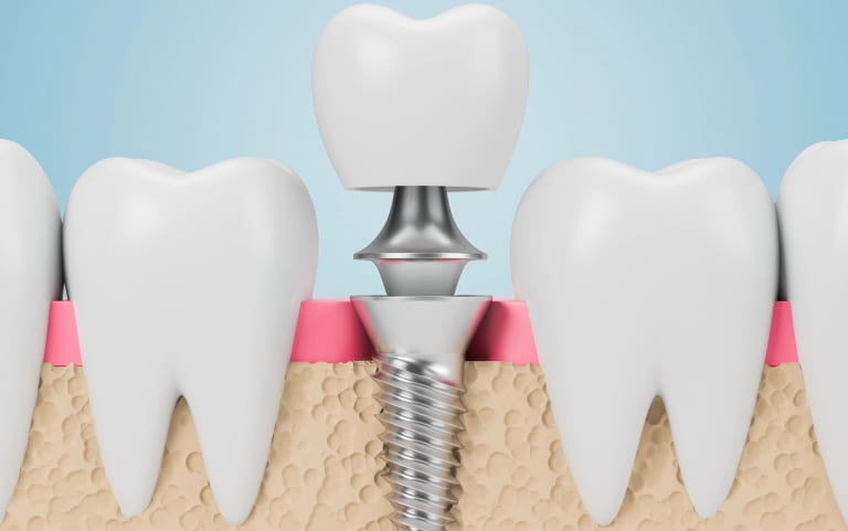 Типы зубных имплантатов. Что нужно знать