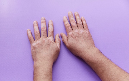 25 июня –Всемирный день витилиго