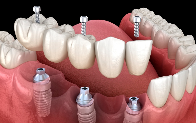 Имплантация зубов: мифы и реальность