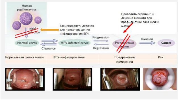 Дисплазия шейки матки > Клинические протоколы КР 2023 (Кыргызстан) >  MedElement