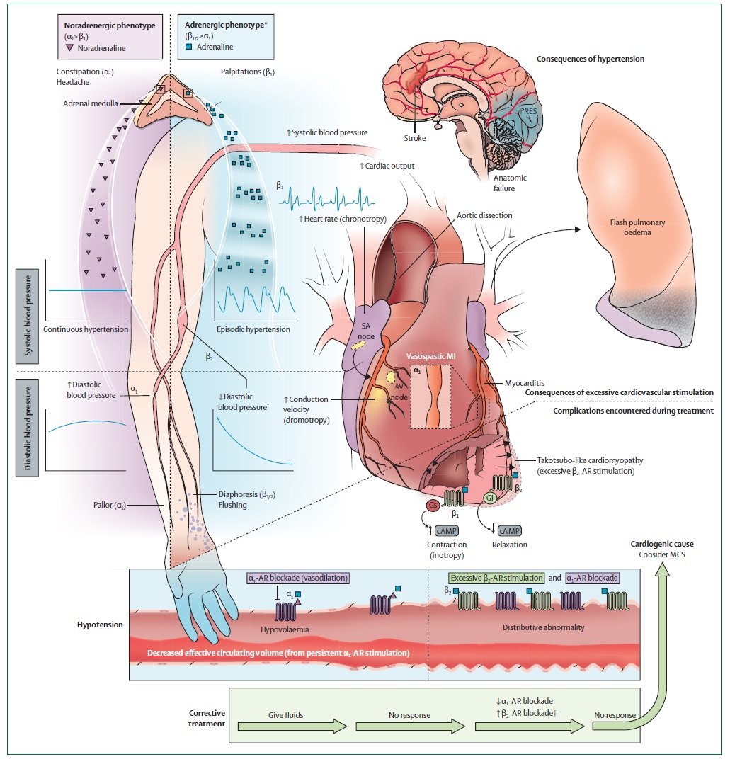 Гипертонические кризы, вызванные катехоламинами: современное понимание и  лечение (Lancet Diabetes & Endocrinology, декабрь 2023)