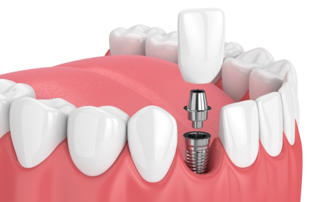 Dental implantation: myths and reality